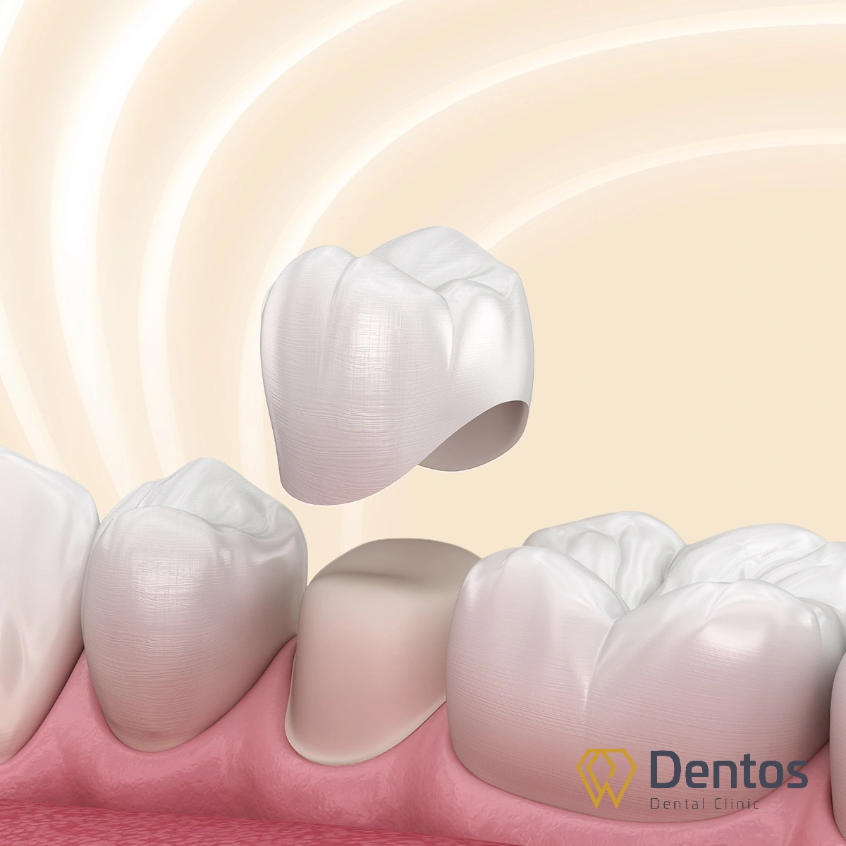 Cấu tạo răng sứ bọc ngoài cùi răng thật giúp bảo vệ răng khỏi vi khuẩn và mòn men